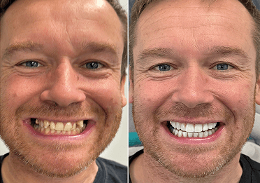 Composite Bonding & Veneers